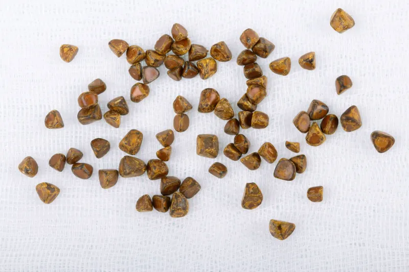 Vad gallsten egentligen är